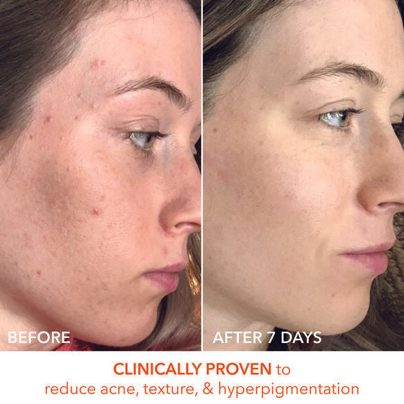 Dr Dennis Gross Skincare Alpha Beta Universal Daily Peel