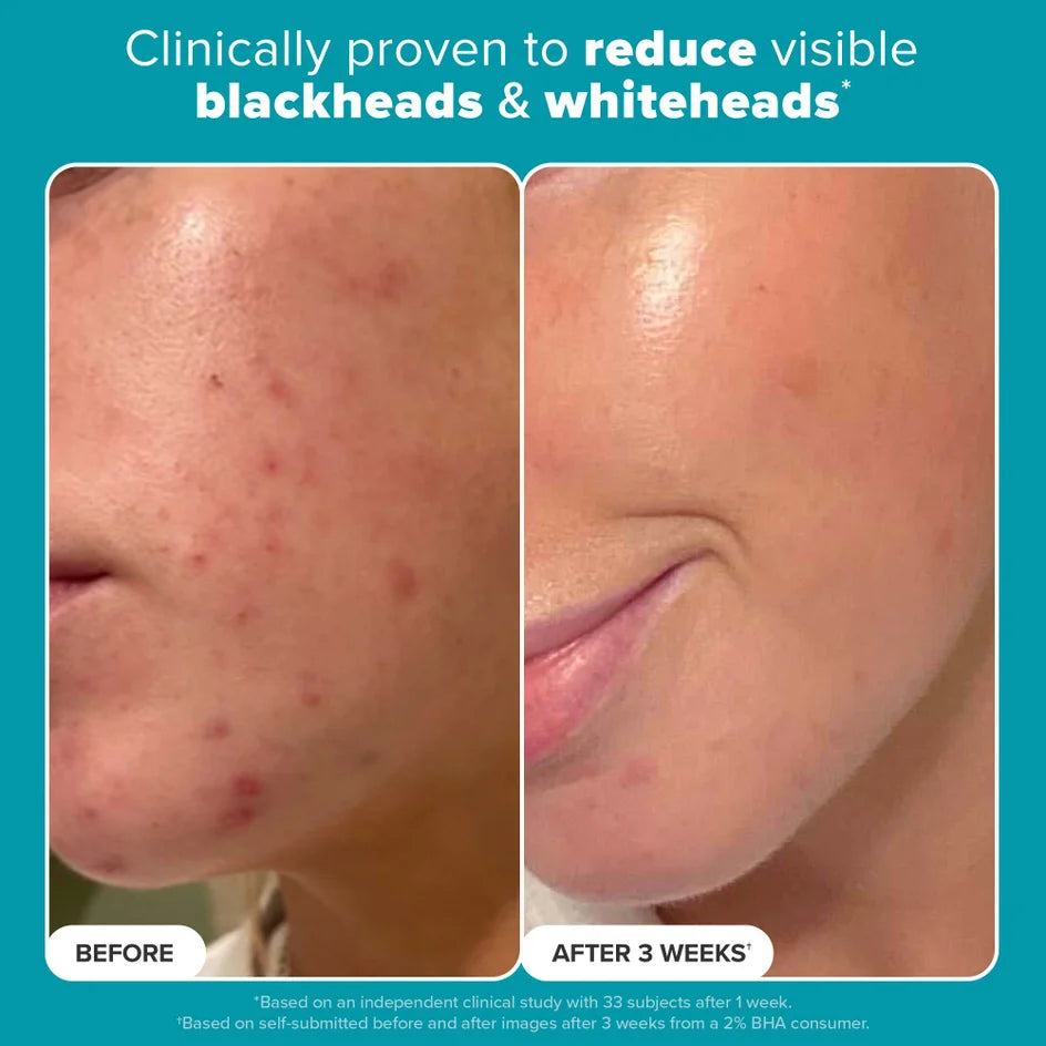 Paula's Choice Skin Perfecting 2% BHA Liquid Exfoliant — Full Size 118 ml
